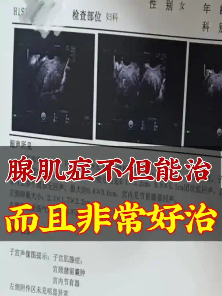 腺肌症不但能治，而且非常好治