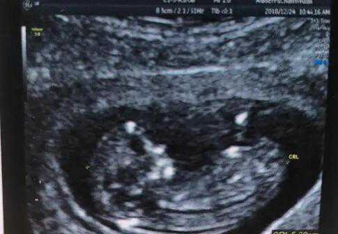 北京二胎男方生育津贴多少钱 12022年北京301医院做供卵试管生男孩需要多少钱 ‘b超如何测男女’