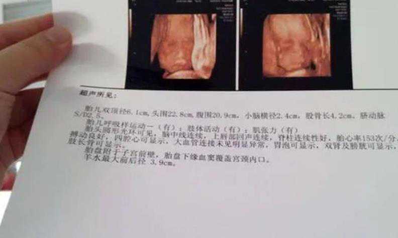南京试管医院 南京居民证办理 ‘四维彩超肾孟分离，是男宝’