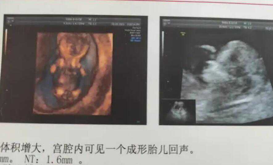 35岁做试管婴儿成功率有多高?