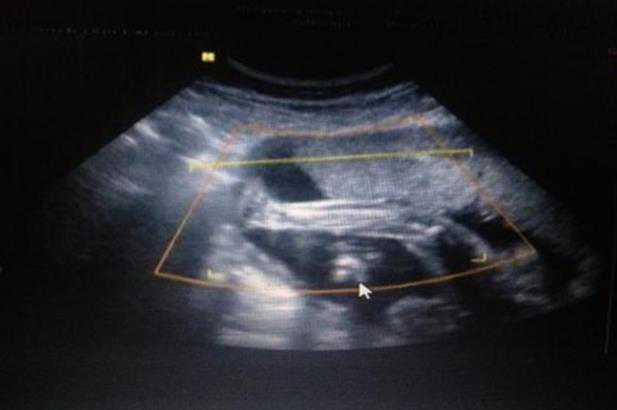 试管婴儿为什么在肚子上打针?怎么给自己打针?