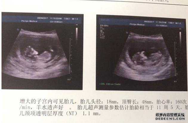 找到杭州试管供卵 在杭州做三代试管如何提高成功率 ‘孕囊22×10是男孩女孩’