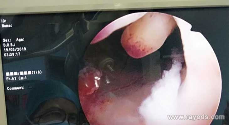 不同情况女性做宫腔镜检查的危害不一样
