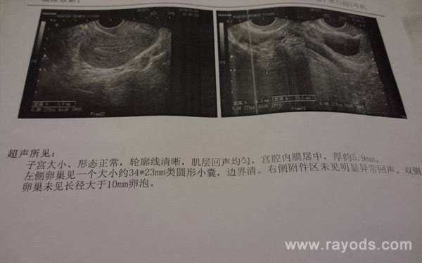 卵泡萎缩B超单